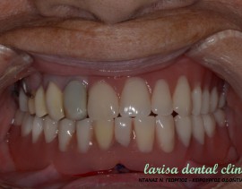 Επένθετη οδοντοστοιχία σε 2 εμφυτεύματα με συνδέσμους locator