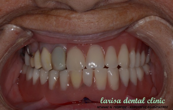 Επένθετη οδοντοστοιχία σε 2 εμφυτεύματα με συνδέσμους locator